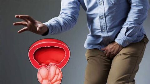 hogyan lehet megbetegedni a prostatitisben