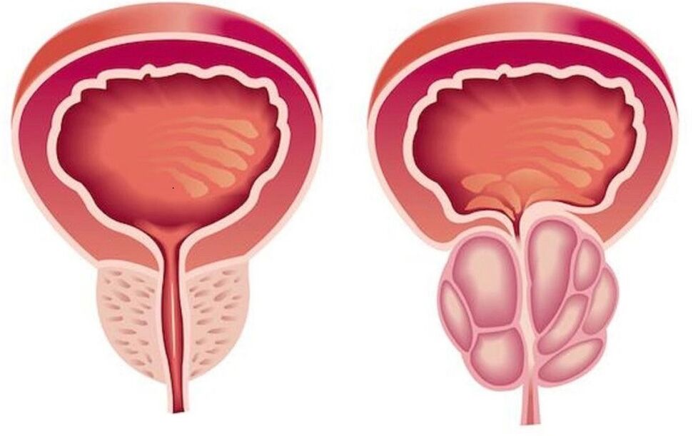 здрава и възпалена простата с простатит